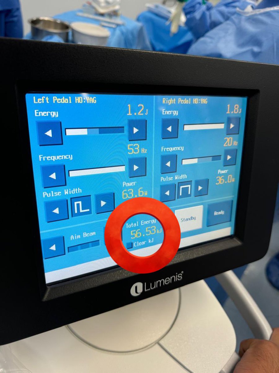 Comparación energía #HoLEP

Menos energía en Watts se traduce en menor KJ, lo que ⬇️ desgaste de los Bricks (cavidades) ⬆️ vida útil del láser y de la fibra ⚡️

⏱️ Qx y próstata similares ~80-100 cc

<a href="/RomanCarvajal/">DR CARVAJAL</a> <a href="/urobraulio/">MD Braulio O. Manzo</a> <a href="/felipeglezglez/">felipe gonzalez</a> <a href="/Endo_Society/">Endourological Society</a> #UroSoMe