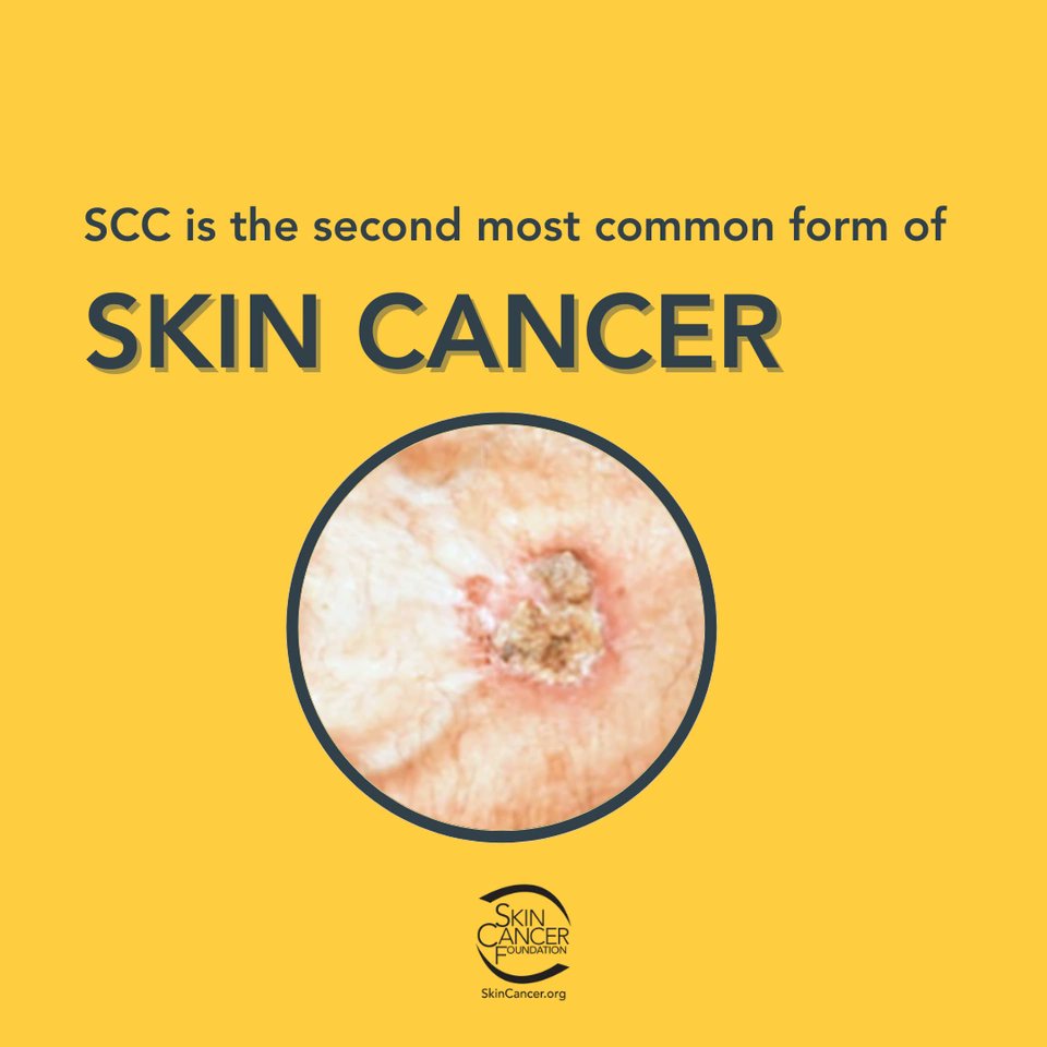 SkinCancerOrg's tweet image. Squamous cell carcinoma (SCC) is one of the most common forms of skin cancer, and early detection can make all the difference. Learn more about what to look for and how to protect yourself. Stay informed, stay protected! Learn more here #SkinCancerAwareness #SCC #SunSafety