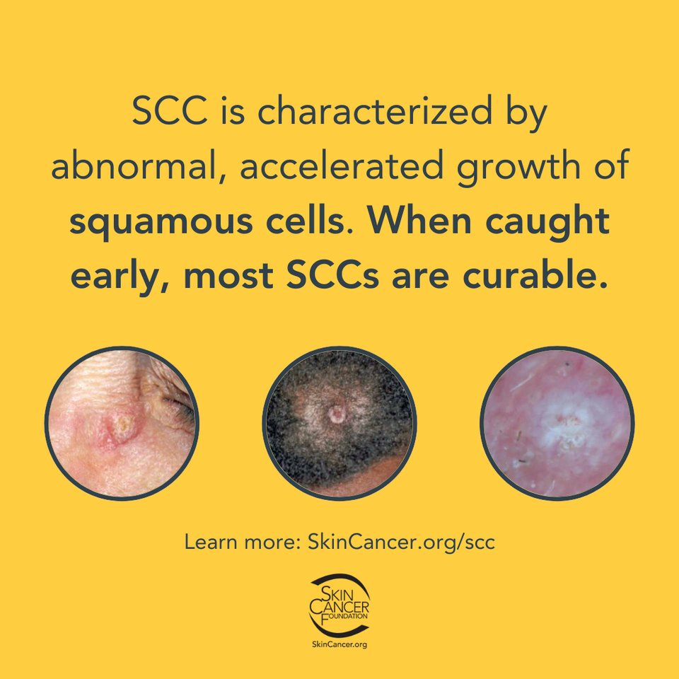 SkinCancerOrg's tweet image. Squamous cell carcinoma (SCC) is one of the most common forms of skin cancer, and early detection can make all the difference. Learn more about what to look for and how to protect yourself. Stay informed, stay protected! Learn more here #SkinCancerAwareness #SCC #SunSafety