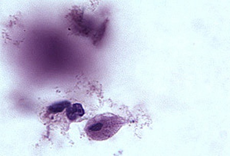 Clinicians: get updated #trich treatment and management options.  cdc.gov/std/treatment-…
