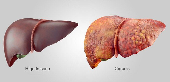 PropositoyVida's tweet photo. La cirrosis hepática no empieza con vómito de sangre.

Empieza con cansancio, hinchazón y excusas para seguir bebiendo.

Y cuando aparecen los síntomas reales… muchas veces ya es irreversible.

Aquí tienes 8 verdades que necesitas saber (aunque duelan): 🧵 https://t.co/PcOLfzx774