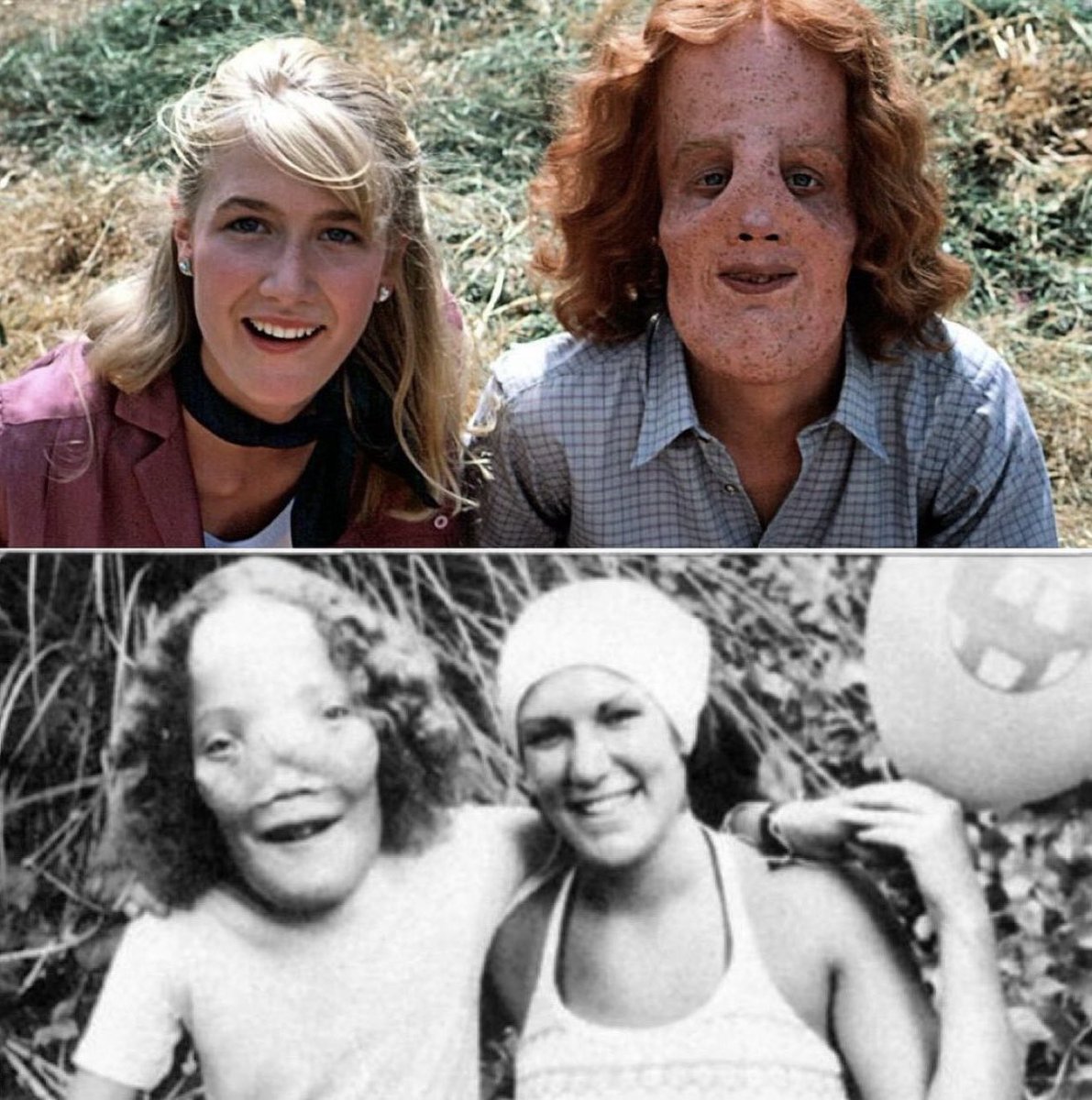 The film 'Mask' (1985) is based on the true story of Roy Lee "Rocky" Dennis,  an American boy who had craniodiaphyseal dysplasia, an extremely rare  sclerotic bone disorder that occurs in approximately