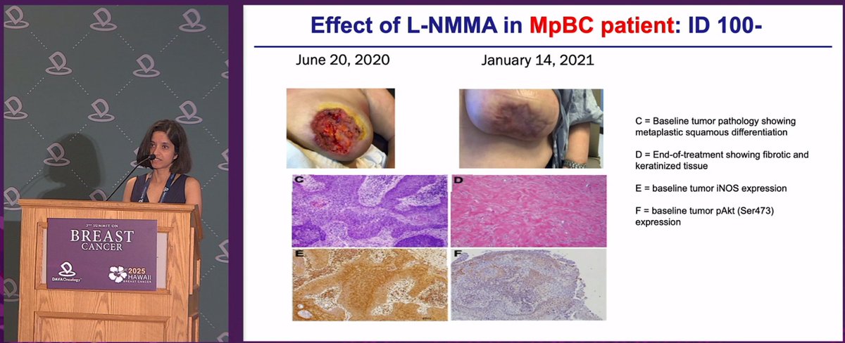 DAVAOnc's tweet image. From bench to bedside in #MpBC! Dr. Polly Niravath of @MethodistHosp presents translational evidence that iNOS inhibition plus chemotherapy may impact tumorbiology, with biomarker-defined strategies now advancing into the clinic.
#DAVABreast #BreastCancer
