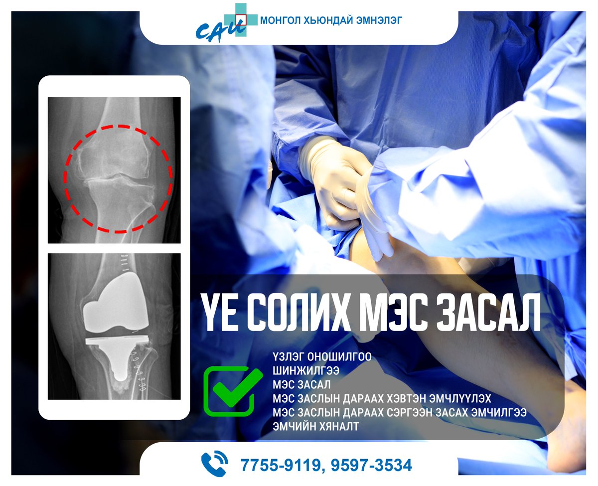 #үе_солих_мэс_засал
-Манай эмнэлэг нь өвдөг, түнхний үе солих мэс заслыг олон жилийн туршлагатай БНСУ-ын Хьюндай нэгдсэн эмнэлгийн захирал, Гэмтэл согог заслын эмч Ким Бү Соб эмч маань чадварлаг багтай хамтран тогтмол хийж, олон олон үйлчлүүлэгчийг талархлыг хүлээсээр байна.