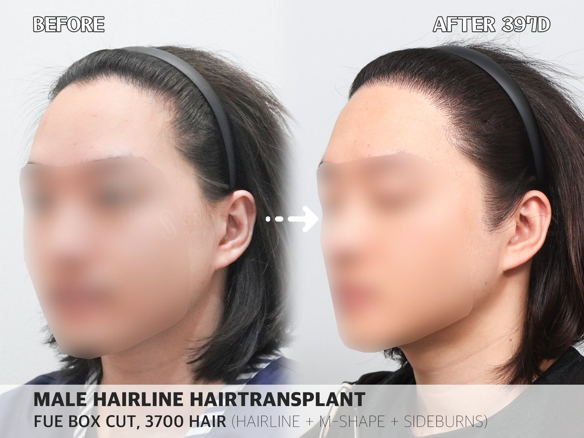 seojinps_eng's tweet photo. Men’s Pride 👍🏻 Sideburn Hair Transplant ✌🏻
Adding sideburns can sharpen your facial contour, make your face look slimmer, and create a stronger, more defined impression.
#HairTransplant #ForeheadReduction #HairlineCorrection #AfterHairTransplant #Hairloss #KoreaTravel #Kbeauty https://t.co/UStpa6Tzj1