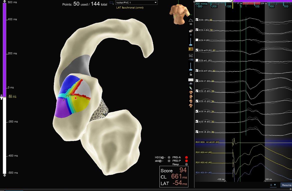 PVCs tried to disappear, but HD GridX doesn’t miss 🎯 Clear signals, exact target, great outcome with <a href="/sumitvermaep/">Sumit Verma</a> #AbbottEP <a href="/AbbottCardio/">Abbott Cardiovascular</a> #EPeeps #EnsiteX #HDGridX