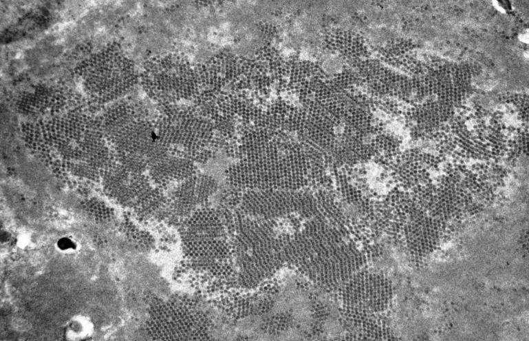 grace_choung's tweet image. Polyomavirus virions can appear in clusters or in paracrystalline arrays within the nucleus and cytoplasm of epithelial cells (most often tubular epithelial cells in medulla and deep cortex) and lumen.
#electronmicroscopy #renalpath