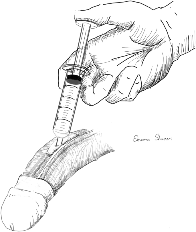 yoursexmedjour's tweet photo. Shaeer’s hydro-inflation technique for neurovascular bundle mobilization during penile surgery 👉https://t.co/VLbl9blsii

@OsamaShaeer @DrAhwany @kamal_shaeer https://t.co/V1W0vea9tS