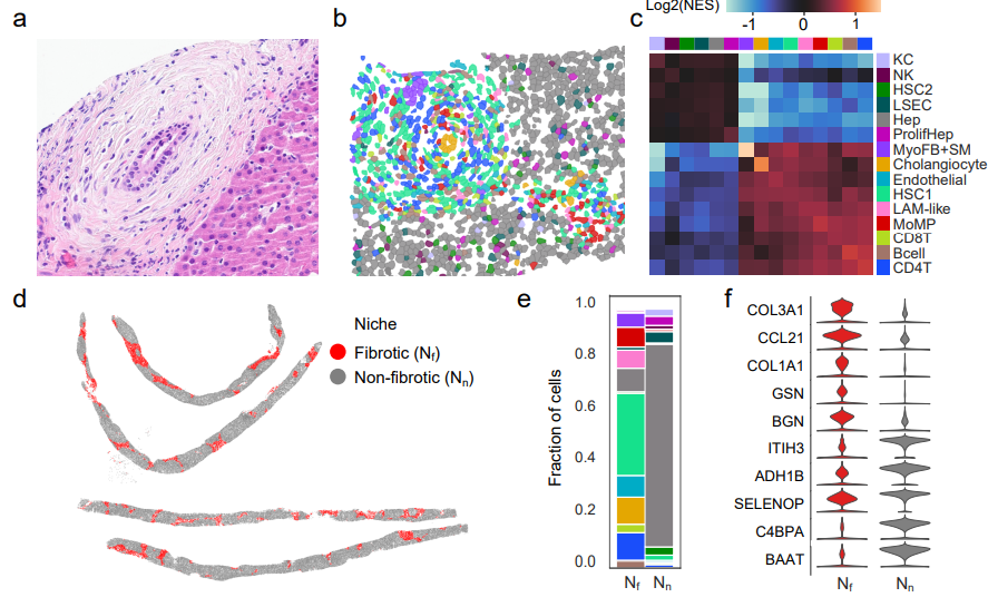 LabWaggoner's tweet photo. @biorxivpreprint @Yunguan10 @CincyResearch #Miraldi #Miethke
Macrophages drive a fibrogenic gene program of periductal fibroblasts in pediatric primary sclerosing cholangitis #PSC
https://t.co/vMZDIDdAgd https://t.co/M6Nxt9xsPZ