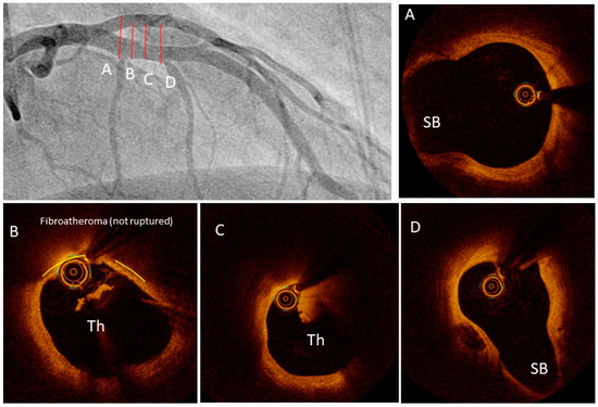 JCM_MDPI's tweet photo. #mdpijcm
#Editor’s Choice Paper🔍
Innovations in #Intracoronary_Imaging: Present Clinical Practices and Future Outlooks
👉https://t.co/mf0k0lK3oE
Citations 6👏
by Andreas Mitsis et al. @mitsis_andreas
@MediPharma_MDPI https://t.co/kOWypeElVz