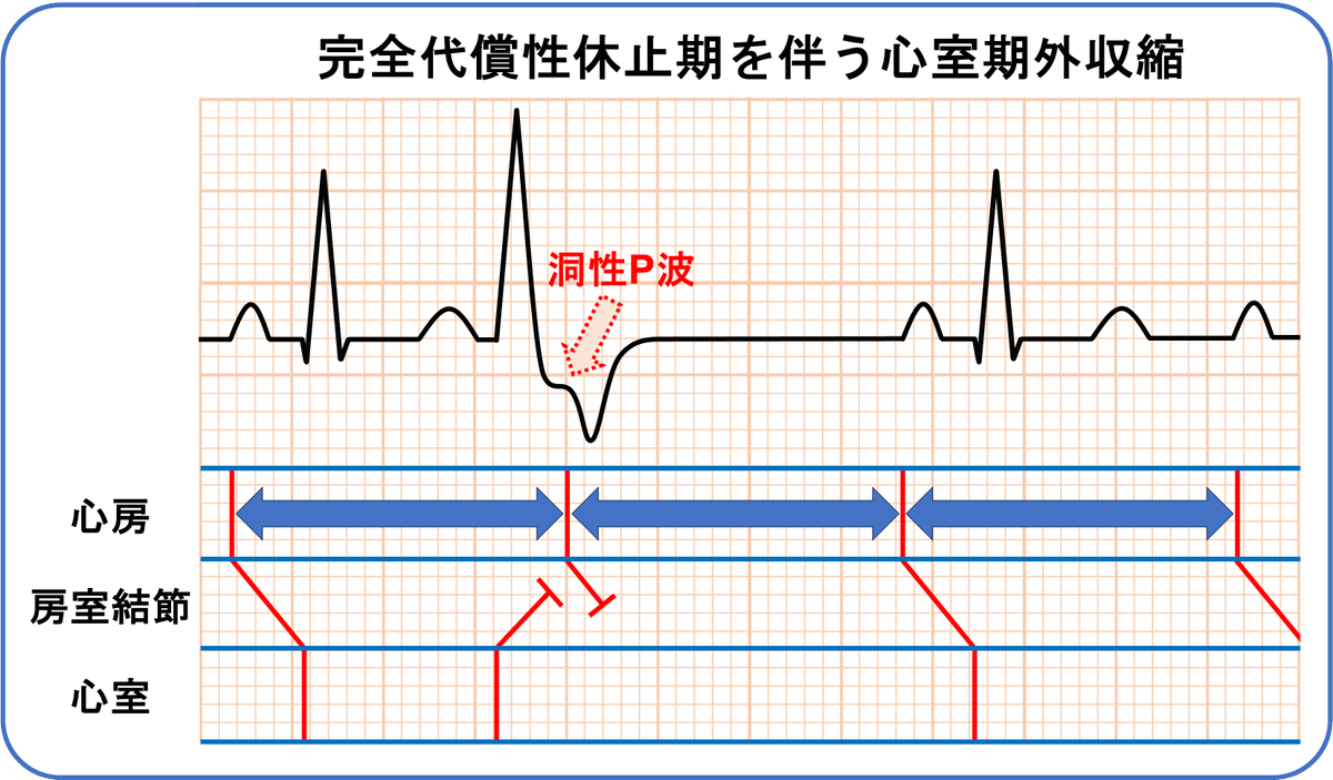 完全代償性休止期を伴う心室期外収縮では洞性P波はしばしば心室期外収縮の波形に重なるので見えにくいことがあります。その為、PP間隔(RR間隔)が正常のPP間隔(RR間隔)の２倍になっていることを確認する必要があります。