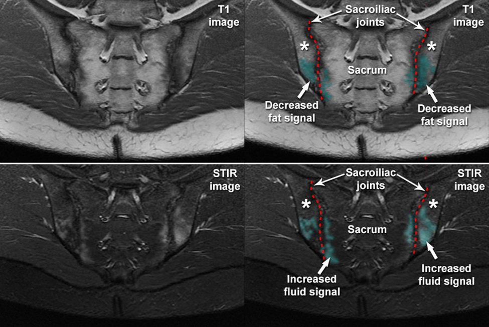 AkzR255385's tweet photo. 🩺 Diagnosing sacroiliitis on MRI? (#2- detail)
 Follow this thread fir systematic approach to improve your skills! 
📸 From basic reading to SPARCC scoring, here’s the essentials. #Radiology #Sacroiliitis #MRI #ASAS #Ankylosing 

@IhabFathiSulima @RheumNow @Janetbirdope @IlliasulK @Rheumat_Aravind @radiologybmj @radiology_rsna