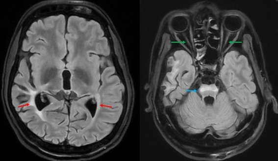 spinacademics's tweet photo. This week’s SPIN-POV: Multidisciplinary collaboration is key to rare diagnoses. Childhood DM, visual and hearing loss with MRI showing optic/brainstem atrophy, absent post pituitary brain spot, T2 hyperintensities in brainstem/optic tracts point toward DIDMOAD (Wolfram) syndrome https://t.co/dRYCOZrqly