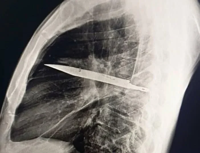 A 44-year-old man went to the hospital after pus began oozing from his chest, where doctors discovered a knife that had been embedded in his body for eight years. According to the report, he showed no signs of chest pain, breathing problems, coughing, or fever, and was otherwise