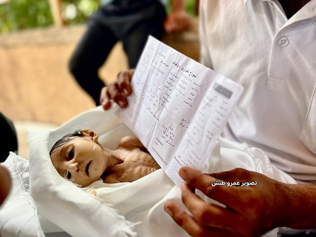 Beş aylık Filistinli bebek Ghadeer Baraka, İsrail ablukası ve kıtlık nedeniyle Han Yunus'ta şiddetli malnütrisyon sonucu hayatını kaybetti.