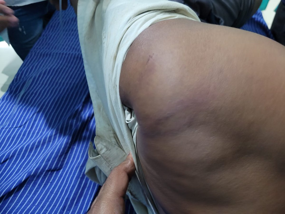 मध्यप्रदेश 9 दिन तक अस्पताल में जिंदगी और मौत से जूझता एक दलित युवक, जिसकी मां भी अस्पताल में भर्ती थी। डॉक्टरों ने खुद पुलिस को सूचना दी, लेकिन थाना प्रभारी अरुण शर्मा और उनकी टीम FIR दर्ज करने तक नहीं पहुँची। अस्पताल से डिस्चार्ज होते ही जब पीड़ित अपनी आखिरी उम्मीद लेकर थाने