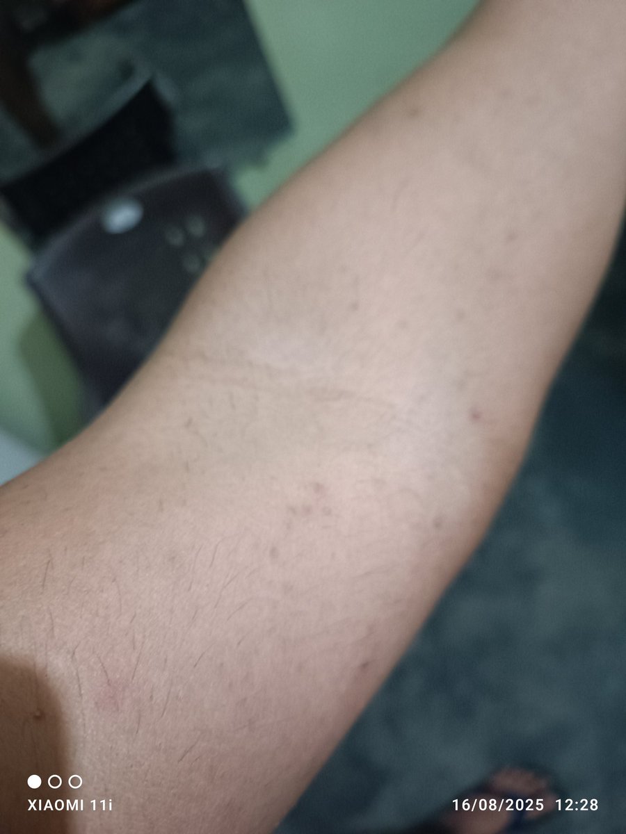 AnmolCh32045913's tweet photo. @Philips @philipsindia My 2 month old body trimmer's turned my skin into a bumpy battlefield! Complaint filed on the 16th, countless calls made, yet I'm still waiting for a fix. Is this how you treat your customers? Time to step up and smooth things out! 😡 https://t.co/eZJjfbQUFu