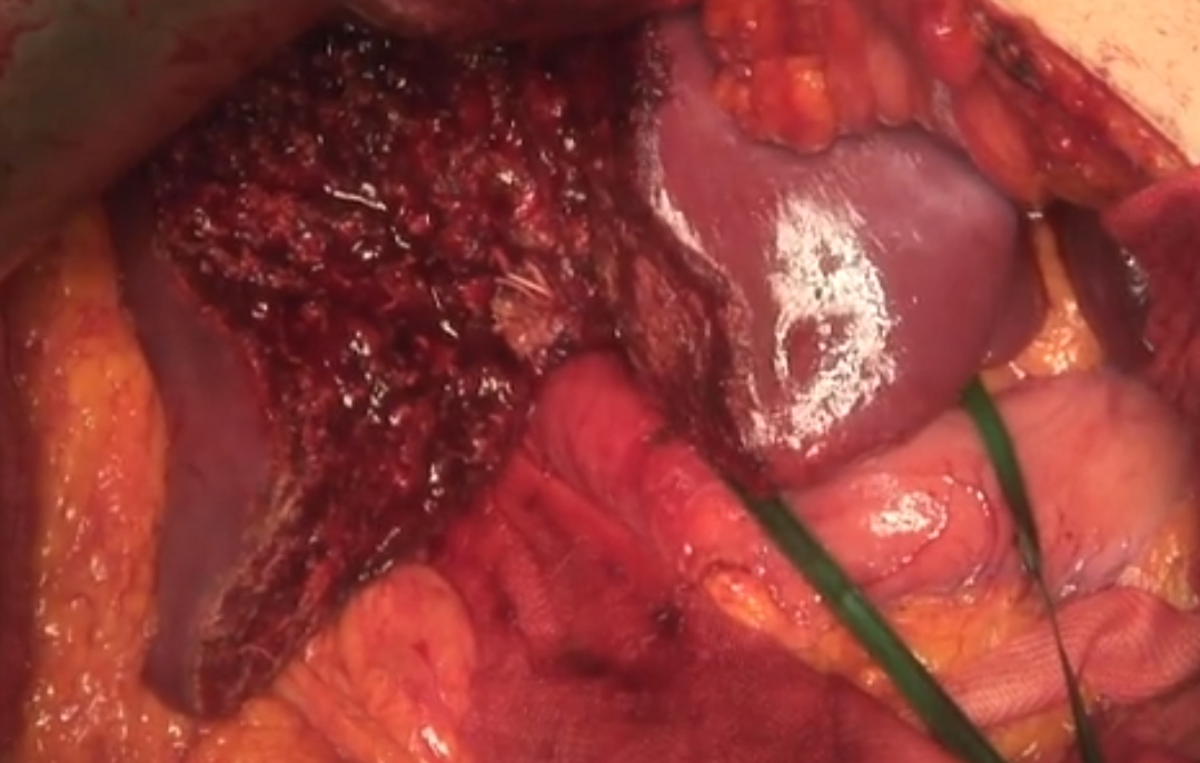 MartinHuerta96's tweet photo. Excited to share our article in TGH on Versatile Applications of ICG in Liver Segmentectomy for regional cholangitis! Honored to collaborate and learn from pioneer Prof. T. Ishizawa. 
Check out the video!🎥
https://t.co/BAohl67c90
https://t.co/RQmzMvfxqn https://t.co/5eap5Z4fS2