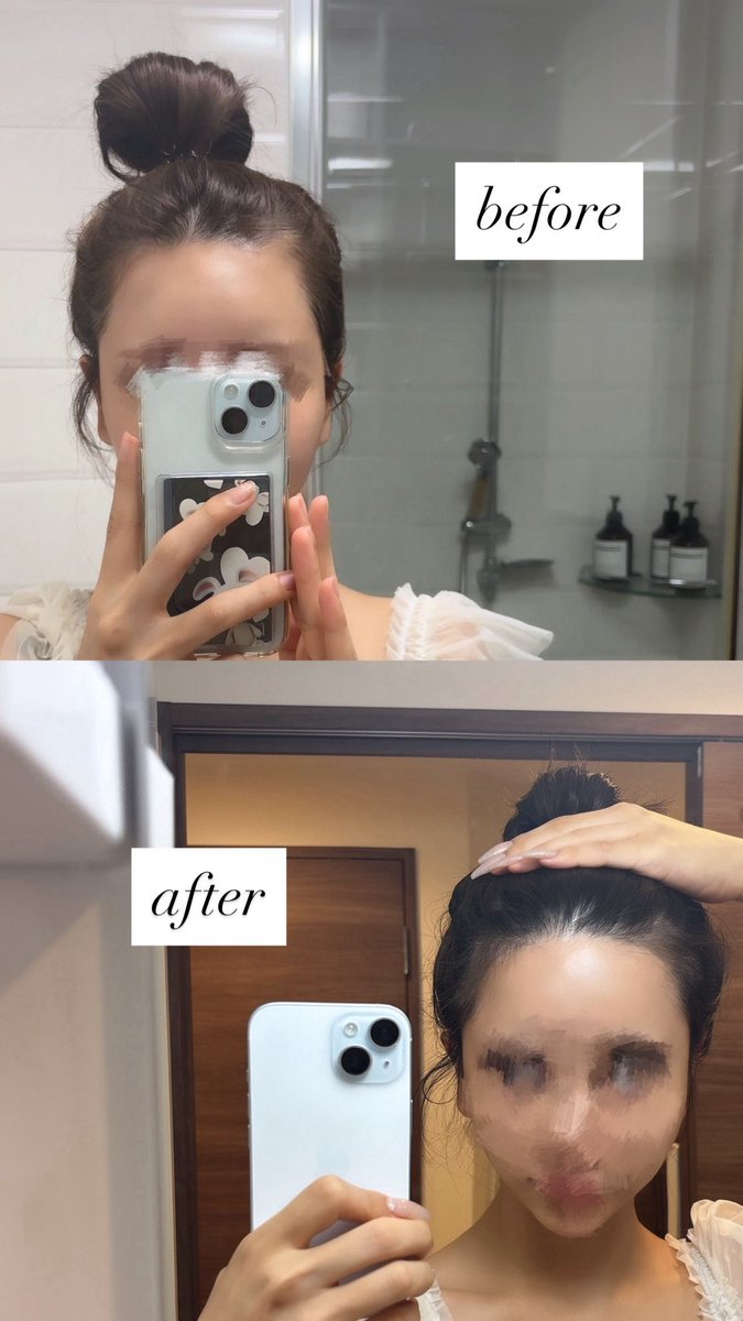 _sachkm's tweet photo. 韓国に住んでいた頃からずっと気になっていたRIA beautyさんのヘアラインアート
今回やっと施術を受けたのですが、整形級に印象が変わって感動しました🥹✨
おでこが丸く整って余白も気にならなくなり、本当にやってよかったと感じています。
施術中の痛みもほとんどなく、デザインも希望に合わせて丁寧に調整していただけました。
すでにリタッチの予約も済ませているので、次回の仕上がりも楽しみです💐