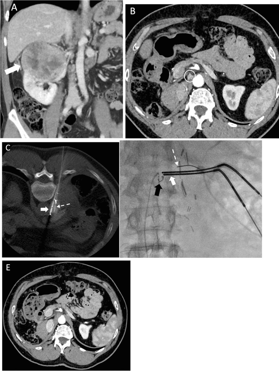 CVIR_Journal's tweet photo. Read now in CVIR 📖
Beyond the Scalpel: the Role of Image-Guided Thermal Ablation in Management of Metastatic Renal Cell Carcinoma in the Era of Immunotherapy
https://t.co/6LjgLrcIr1 https://t.co/x6NyNAbwtH