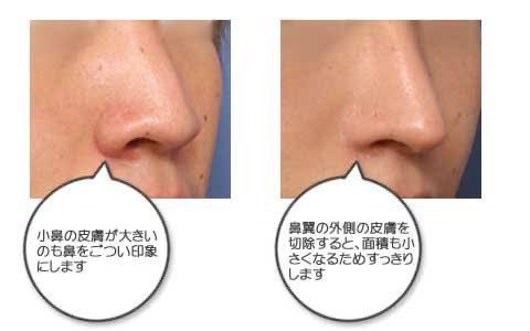 ヴェリテのこの症例も自分の中では伝説
これ見て鼻翼縮小外側やったもん(ヴェリテでは無いけど)