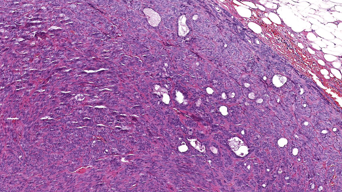 What’s this breast lesion? 🔬

Cast your vote below 👇

Answer revealed Monday!

#PathX #PathTwitter #breastpath #PathQuiz