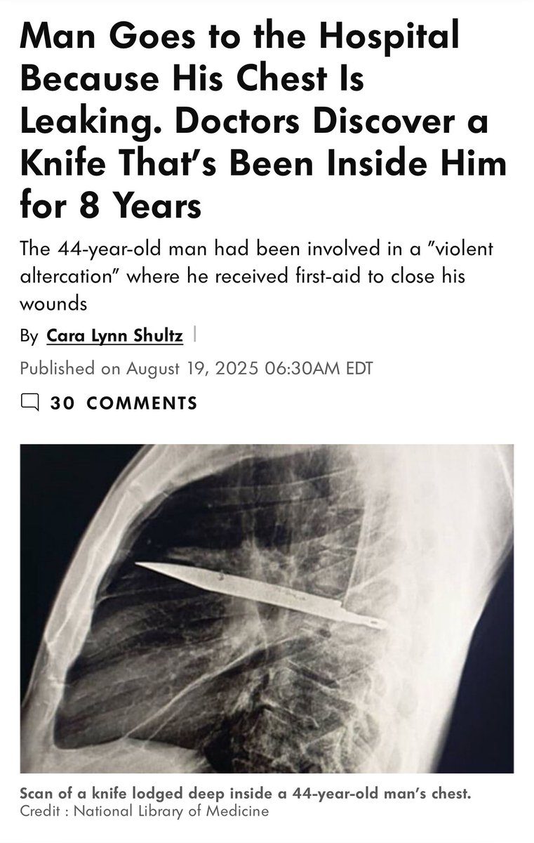 <a href="/Rainmaker1973/">Massimo</a> Here are The Facts 🤙🏽

Thanks for the tag <a href="/himalarich/">himala</a> 

Follow to tag when a post is needing context 🤙🏽

Man Discovers Knife in Chest After Eight Years 
July 24, 2025 
Dar es Salaam, Tanzania

Facts: 
On July 24, 2025, a 44-year-old Tanzanian man sought medical care at Aga Khan