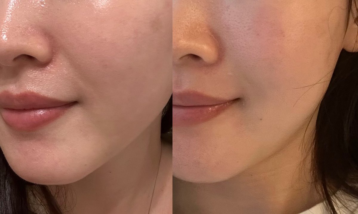 ヒアルロン酸1本でここまでほうれい線がキレイになるとは…！これだからヒアルロン酸はやめられない。

👇🏻ほうれい線治療解説しますっ❤️‍🔥