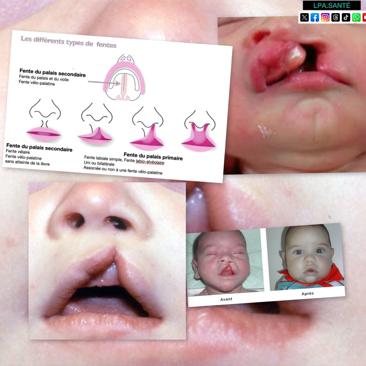 lpasante's tweet image. 🚨🚨
Ce que vous regardez c’est une fente labiale, une malformation congénitale caractérisée par une séparation du lèvre supérieure, due à une absence de fusion des bourgeons faciaux. Parmi les causes figure la carence en acide folique durant le 1er trim de grossesse. #détails 👇🏽