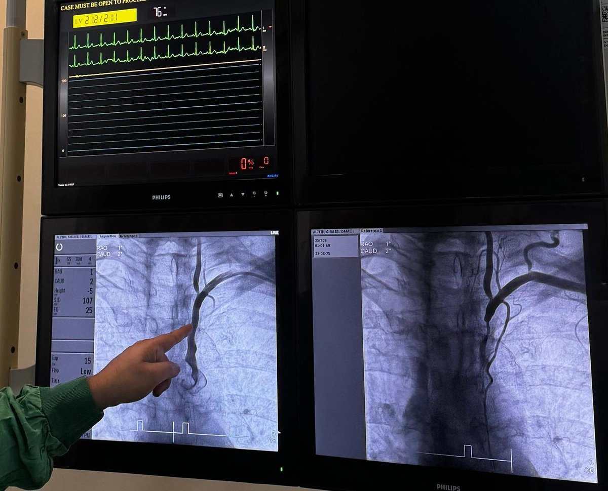 D_Ch_H's tweet image. Left subclavian artery stenting using Skypoint DES with perfect result
#Revascularization #PCI #PTCA #PeripheralVascularDisease
