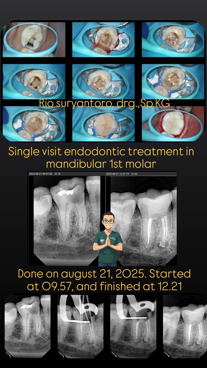Single visit endodontic treatment in mandibular 1st molar
Done on august 21, 2025. Started at 09.57, and finished at 12.21.

#endodontic #endodontist #doktergigi