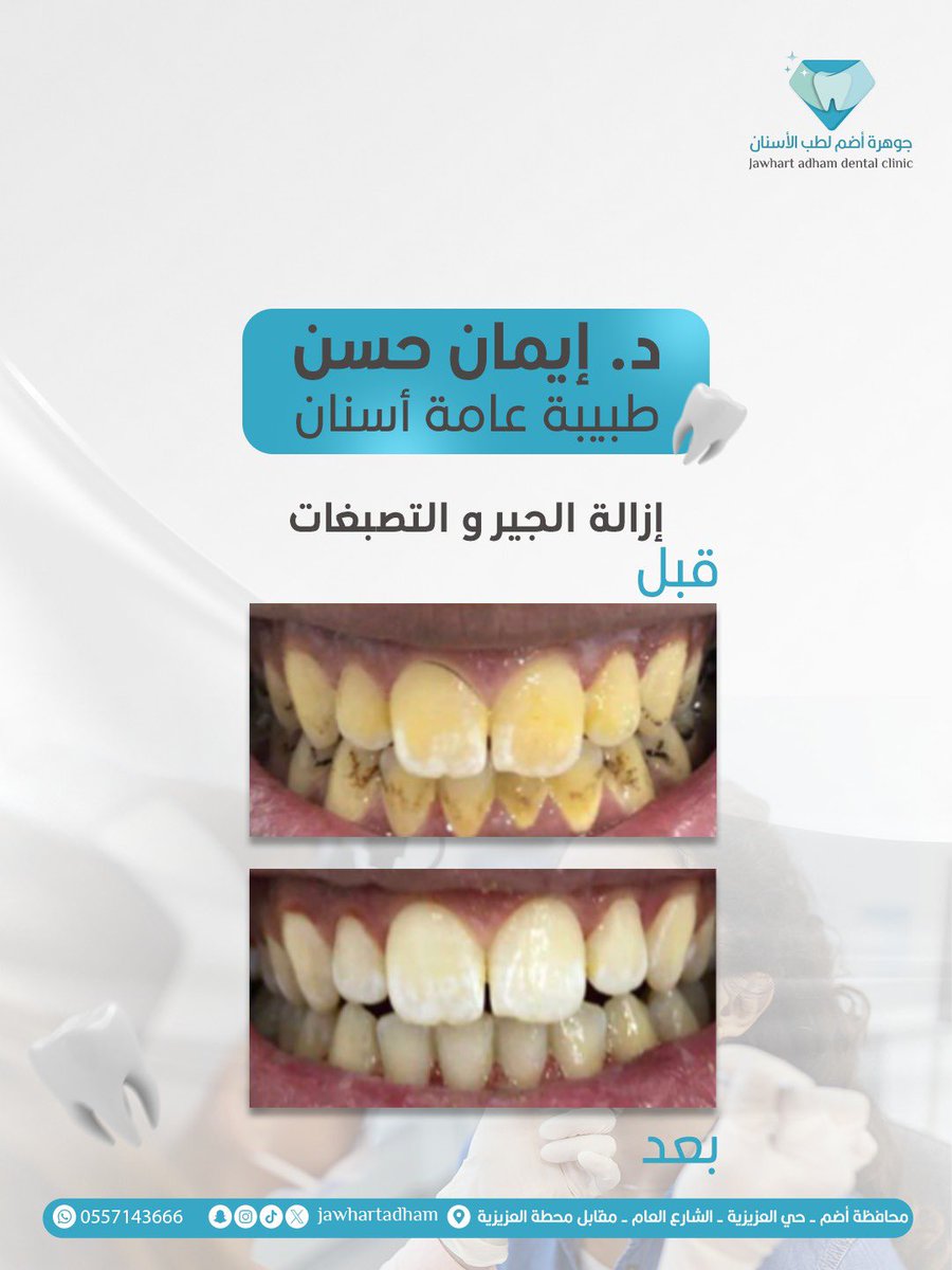 خلي ابتسامتك تحكي عنك مع دكتوره إيمان حسن😍🦷

📍مجمع جوهرة أضم لطب الأسنان
🎯 الجودة - الأمان - التعقيم الكامل - أسعار منافسه 
📍 أضم - حي العزيزيه - الشارع العام 
📞 للحجز والاستفسار: 0557143666

✨
#جوهرة_أضم #جوهرة_أضم_لطب_الأسنان #مجمع_جوهرة_أضم #محافظة_أضم #محافظة_اضم