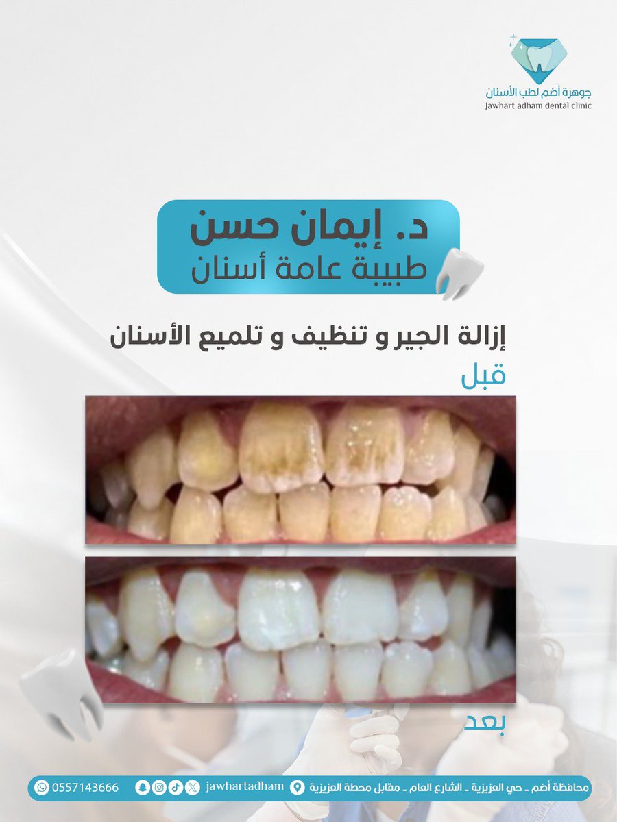 واثق من نفسك؟ ابتسامتك تقول كل شي 😍🦷 مع دكتوره إيمان حسن😍🦷

📍مجمع جوهرة أضم لطب الأسنان
🎯 الجودة - الأمان - التعقيم الكامل - أسعار منافسه 
📍 أضم - حي العزيزيه - الشارع العام 
📞 للحجز والاستفسار: 0557143666
✨
#جوهرة_أضم #جوهرة_أضم_لطب_الأسنان #مجمع_جوهرة_أضم #محافظة_أضم