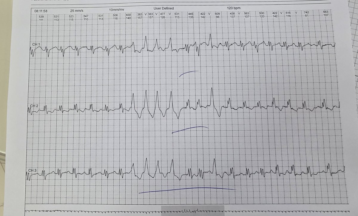 Dx. #ECG #Cardiology