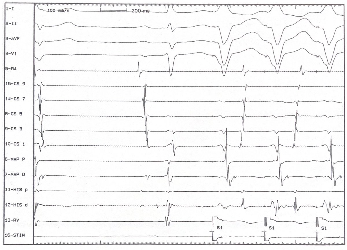 CHART Healthcare Academy (@chartacademy) on Twitter photo #SundaySchool 🫀 Describe the EGM.
📖 Answers post tomorrow! Drop your here today!
🔗 Link in BIO
🌎 linktr.ee/CHARTHealthcar…
Join the Membership
🌱 bit.ly/3SNnPND
📣Connect
🌐 charthealthcareacademy.com
#Epeeps #EGMreview #CaseStudyClub #RCES #CEPS #CRM #DeviceClinic #SundaySchool 🫀 Describe the EGM.
📖 Answers post tomorrow! Drop your here today!
🔗 Link in BIO
🌎 linktr.ee/CHARTHealthcar…
Join the Membership
🌱 bit.ly/3SNnPND
📣Connect
🌐 charthealthcareacademy.com
#Epeeps #EGMreview #CaseStudyClub #RCES #CEPS #CRM #DeviceClinic