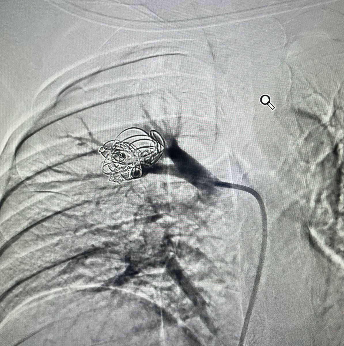 A middle-aged man with a cavitary RUL lung lesion, infection, TB? Presented with hemoptysis. CT showed a Rasmussen aneurysm. Successfully embolized.