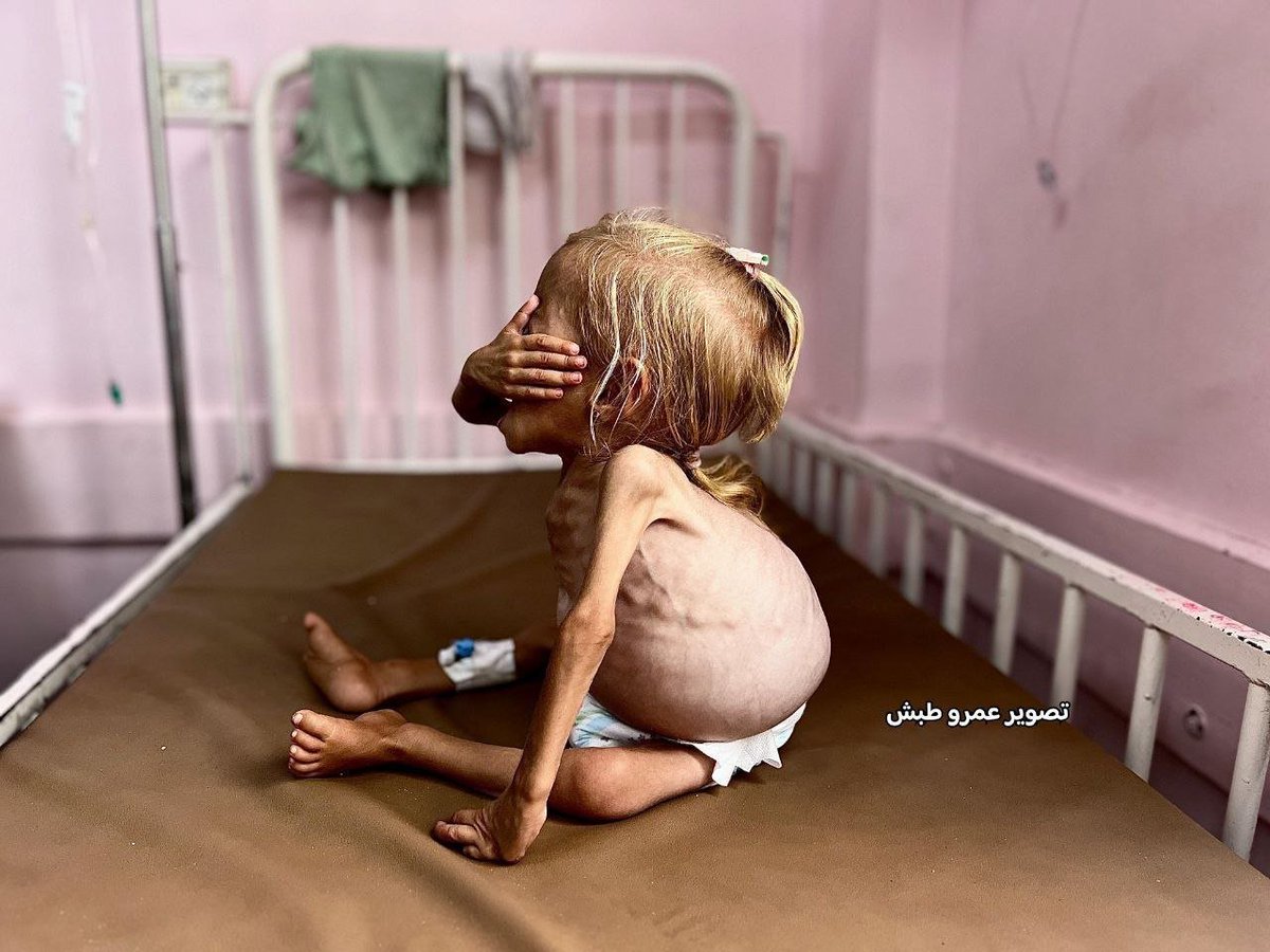tanertimurr's tweet image. Fotoğrafta gördüğünüz Gazzeli Şam Kudeyh isimli çocuk iki yaşında ve yalnızca 4 kilo ağırlığında. 

İsrail&apos;in açlığa maruz bıraktığı küçük kız, açlık nedeniyle hastalıklarla boğuşuyor. 

Gıda yetersizliği ve tıbbi eksikliklerden dolayı tedavi edilemeyen Kudeyh, dünyanın gözü…