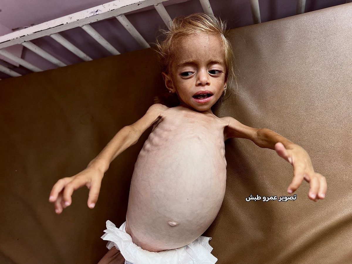 tanertimurr's tweet image. Fotoğrafta gördüğünüz Gazzeli Şam Kudeyh isimli çocuk iki yaşında ve yalnızca 4 kilo ağırlığında. 

İsrail&apos;in açlığa maruz bıraktığı küçük kız, açlık nedeniyle hastalıklarla boğuşuyor. 

Gıda yetersizliği ve tıbbi eksikliklerden dolayı tedavi edilemeyen Kudeyh, dünyanın gözü…