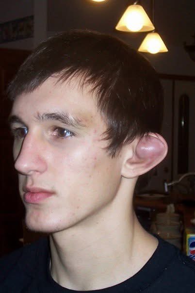 Back in 2005 I had to go up to the University of Iowa to get my cauliflower ear drained and the nurses said that was most fluid they had ever drained off an ear before.