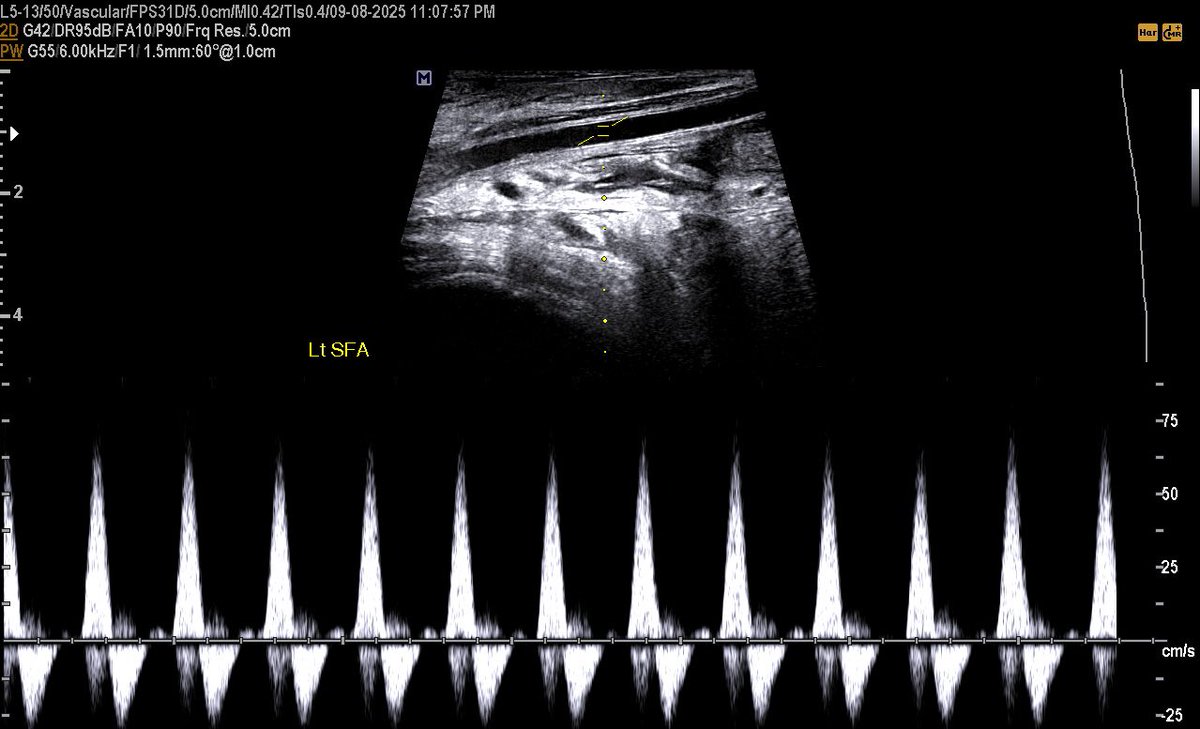 EchoTech_4's tweet image. Extensive DVT and SVT in 43 years female with a history of Ovarian cancer underwent neo adjuvant chemotherapy.

In such cases the operator must assess the arterial system to exclude the possibility of Phlegmasia cerulea dolens.

#EchoTech