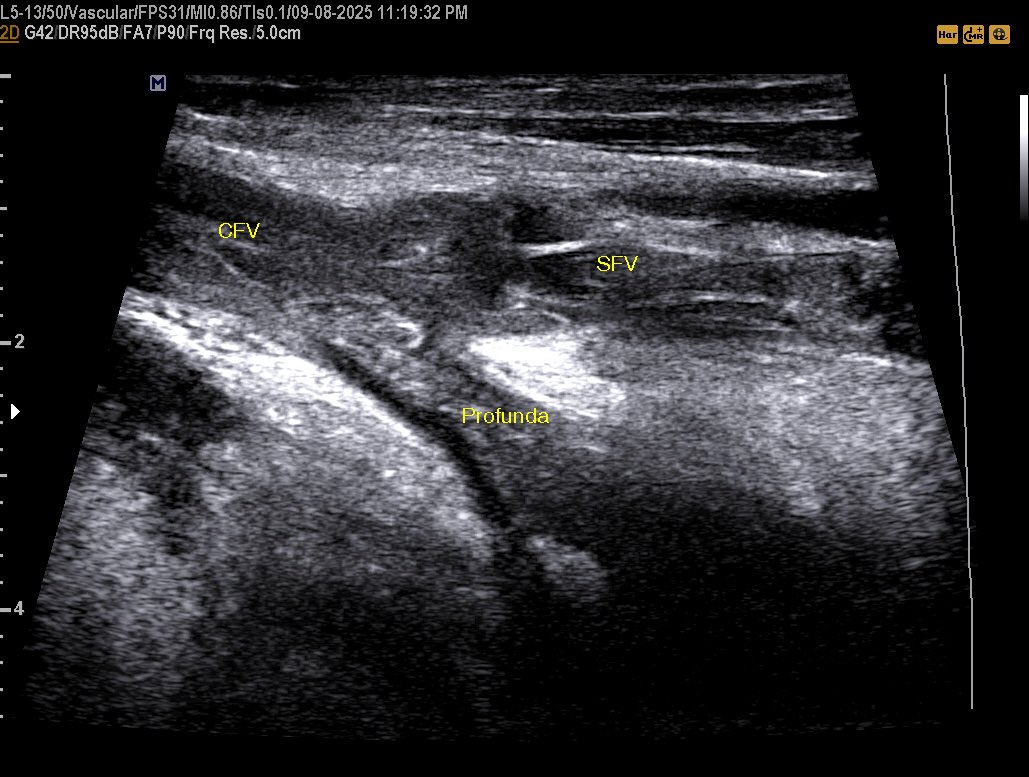 EchoTech_4's tweet image. Extensive DVT and SVT in 43 years female with a history of Ovarian cancer underwent neo adjuvant chemotherapy.

In such cases the operator must assess the arterial system to exclude the possibility of Phlegmasia cerulea dolens.

#EchoTech