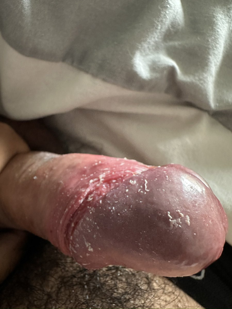 I can actually see everything again 🤩 #dirtydick #smegma #smegmadick #mansmell #cockcheese #dickcheese #chub #cheesycock #gaychub #cheesydick #uncut #gaypig #sebo #gaypig #mansmell #manstink #stinkydick #smegmalovers #ripedick #filthycock