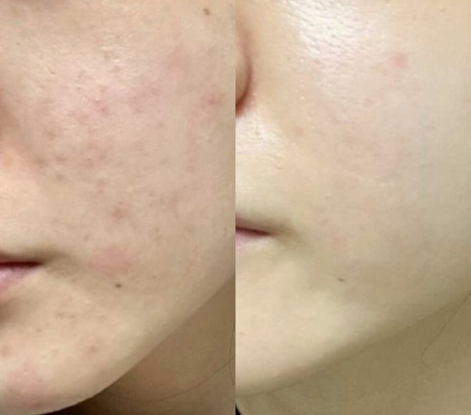 สกินแคร์รูทีนอยากหน้าใส ไร้สิวยกให้ขวดนี้เลย La Roche-Posay EFFACLAR SERUM  สิวอุดตัด สิวอักเสบเอาอยู่หมด ผิวหน้าเรียบและใสขึ้นมากๆ เพราะตัวเซรั่มช่วยผลัดผิวและลดรอย เนื้อเซรั่มทาง่าย ซึมไว ไม่เหนอะ ใช้จนตอนนี้หน้าใสขึ้นมากๆ 100/10👍🏻
🩵bit.ly/3Pm57tA