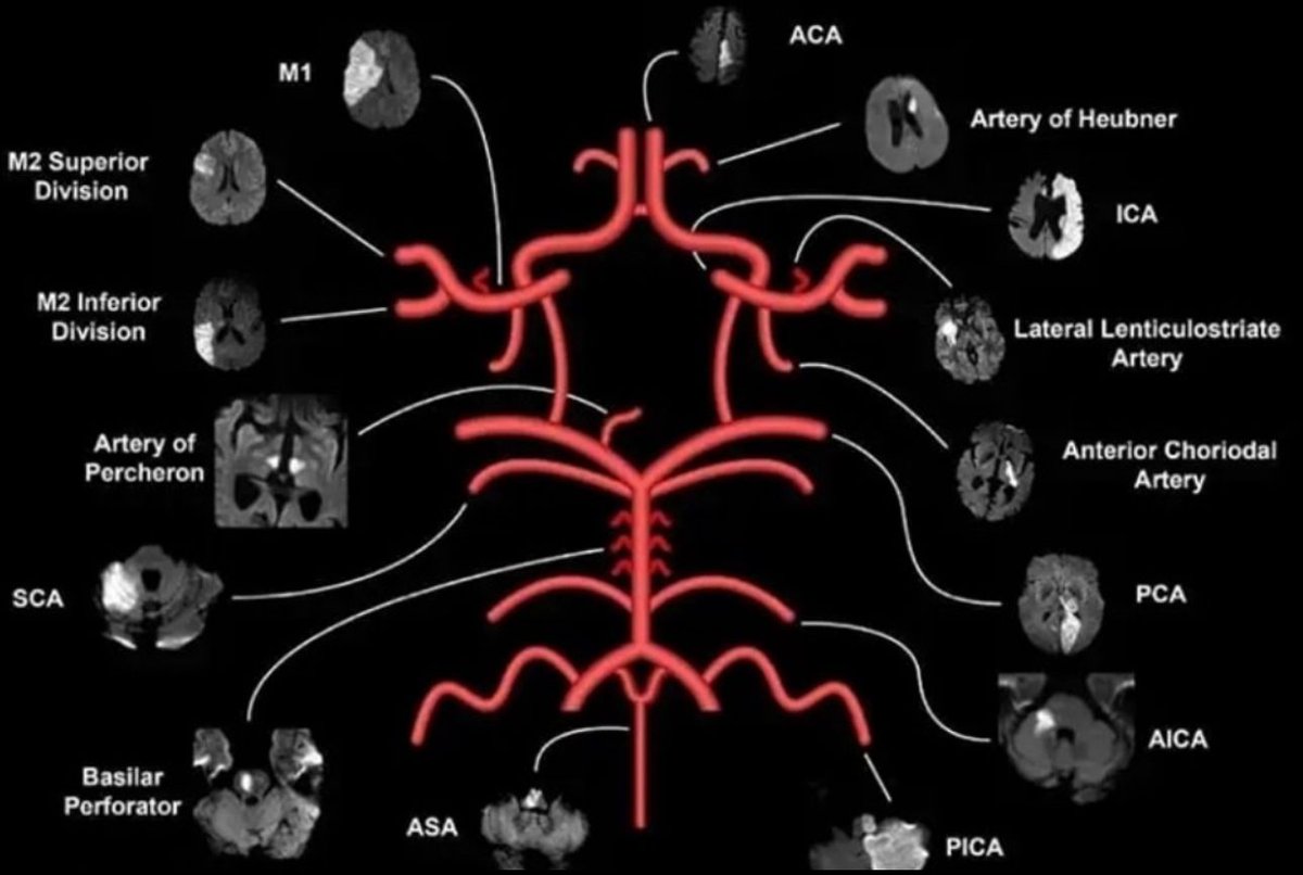 MarlonVFZR's tweet photo. 📌Territorios vasculares cerebrales🧠
⬇️⬇️⬇️⬇️

🩸𝘼𝘾𝘼 (𝘼𝙧𝙩𝙚𝙧𝙞𝙖 𝙘𝙚𝙧𝙚𝙗𝙧𝙖𝙡 𝙖𝙣𝙩𝙚𝙧𝙞𝙤𝙧): Lóbulo frontal medial y paracentral
🩸𝙈1: Ganglios basales y cápsula interna
🩸𝙈2 𝙎𝙪𝙥: Corteza parietal/suprasilviana
🩸𝙈2 𝙄𝙣𝙛: Corteza temporal e ínsula
🩸𝘼𝙧𝙩𝙚𝙧𝙞𝙖 𝙙𝙚 𝙃𝙚𝙪𝙗𝙣𝙚𝙧: Cabeza del núcleo caudado y cápsula interna anterior
🩸𝙇𝙚𝙣𝙩𝙞𝙘𝙪𝙡𝙤𝙚𝙨𝙩𝙧𝙞𝙖𝙙𝙖𝙨 𝙡𝙖𝙩𝙚𝙧𝙖𝙡𝙚𝙨: Putamen y cápsula interna posterior
🩸𝘼𝙧𝙩𝙚𝙧𝙞𝙖 𝙘𝙤𝙧𝙤𝙞𝙙𝙚𝙖 𝙖𝙣𝙩𝙚𝙧𝙞𝙤𝙧: Tracto óptico, globo pálido
🩸𝘼𝘾𝙋 (𝙋𝘾𝘼): Lóbulo occipital y tálamo
🩸𝘼𝙧𝙩𝙚𝙧𝙞𝙖 𝙙𝙚 𝙋𝙚𝙧𝙘𝙝𝙚𝙧𝙤𝙣: Tálamo bilateral y mesencéfalo
🩸𝙎𝘾𝘼: Cerebelo superior y mesencéfalo
🩸𝘼𝙄𝘾𝘼: Cerebelo anteroinferior y puente lateral
🩸𝙋𝙄𝘾𝘼: Cerebelo inferolateral y bulbo lateral
🩸 𝘼𝙎𝘼: Médula espinal anterior y bulbo medial

𝘈𝘳𝘵𝘪́𝘤𝘶𝘭𝘰𝘴 𝘺 𝘮𝘢́𝘴 𝘦𝘯…
👇🏼👇🏼👇🏼👇🏼👇🏼
📑🔗🔑🔓
https://t.co/89ht2mBRSA
👉 [https://t.co/ePWvGBdde7]

#Neuro #NeuroX #Vascular #NeuroVascular  #ClubCrit #UCI #Emergencia #MedEd #CriticalCare #FOAMcc #FOAMed #ManejoClínico #Urgencias #UCI #Enfermería #Emergencias #ClubCrit #Medicina #UCI #FOAMed #FOAMcc #MedTwitter #ICU #POCUS #CriticalCare #MedEd #CuidadoCrítico #MedX #EducaciónMédica #MedIntensiva #MedXCommunity #MedicinaCrítica #MedED #CritCare #ICUManagement #MustRead #LecturaRecomendada