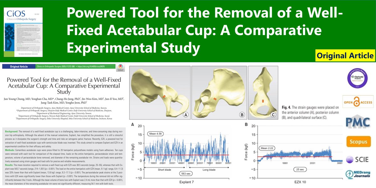 CiOSjournal's tweet image. Powered Tool for the Removal of a Well-Fixed Acetabular Cup: A Comparative Experimental Study
🌷doi.org/10.4055/cios24…
Clin Orthop Surg. 2025 Jun;17(3) Jun Young Chung
#Acetabulum #Arthroplasty #Replacement #Hip #Orthopedic_equipment #Prosthesis_failure