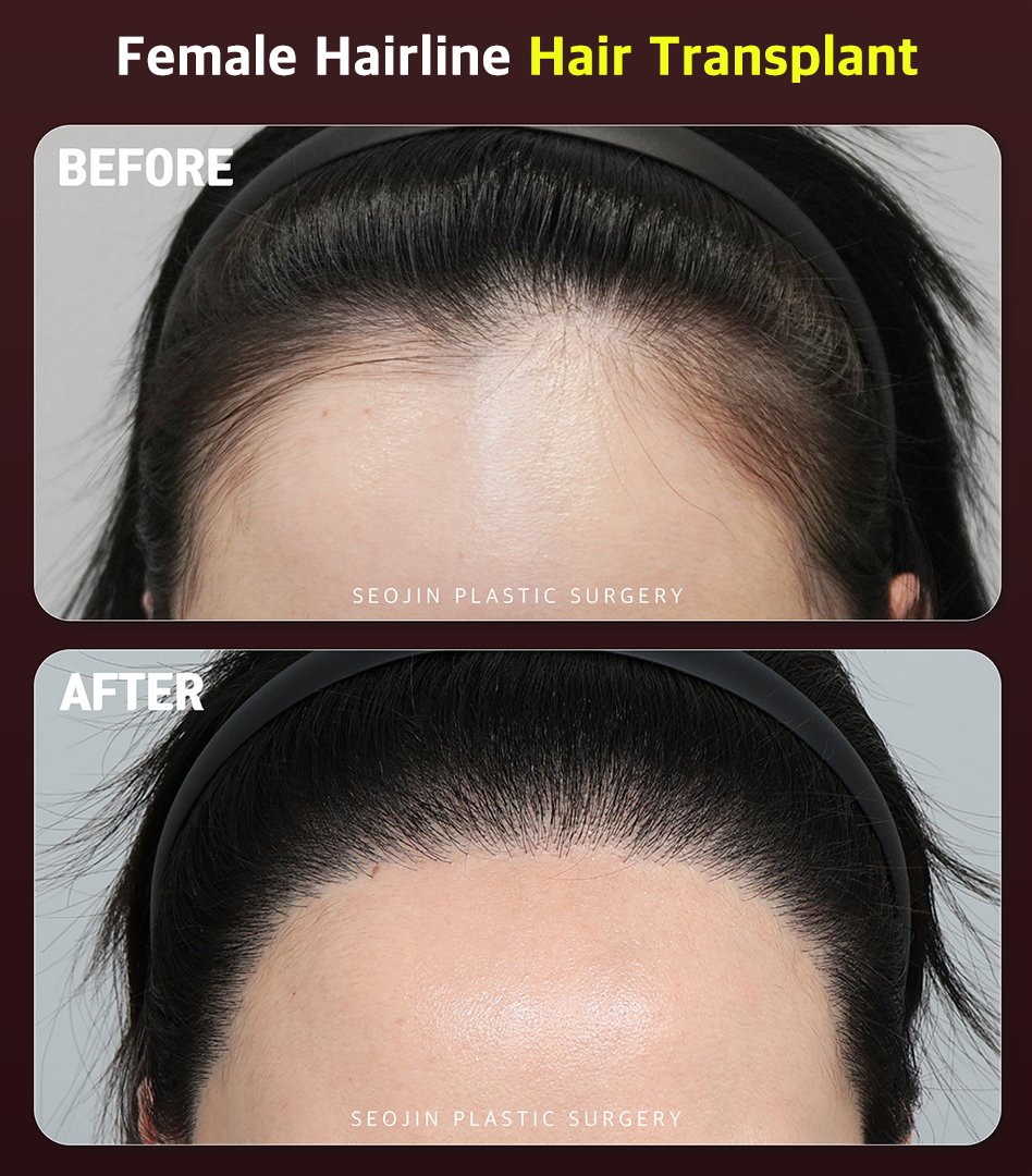seojinps_eng's tweet photo. Big forehead + thinning part? 🤫Transplant the hairline where survival is highest, fill the part with micropigmentation , no wasted grafts, no over-treatment. 📷 Seojin Plastic Surgery: book your consult today!
#HairTransplant #ForeheadReduction #HairlineCorrection #Kbeauty https://t.co/vGUCp0fZ1b