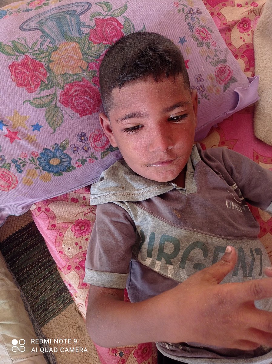 My child's face is swollen today because there is no treatment. He suffers from oxygen deficiency and cerebral palsy, and I cannot afford this medicine. I hope that you will stand by my child and support him so that I can buy him the medicine
. chuffed.org/project/137395…