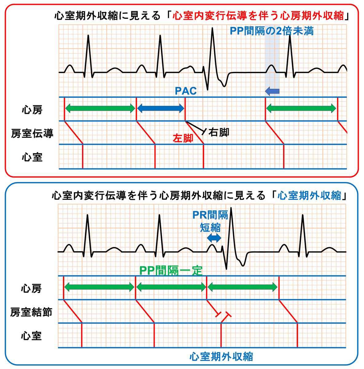 心室内変行伝導を伴う心房期外収縮と心室期外収縮