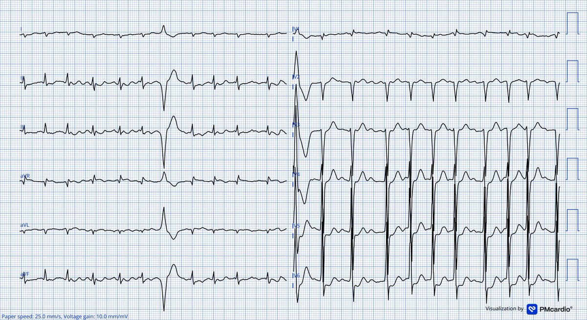 leonr (@leonrmail) on Twitter photo 92y man, diarrhoe with AKI. Have a great Monday everybody 💪 #ECG <a href="/ecgandrhythmRoe/">Dr. Andreas Roeschl</a> <a href="/amalmattu/">Amal Mattu</a> <a href="/koggelnoggel/">Jana Borucka</a> <a href="/TheECGMedic/">Jack Cahill</a> <a href="/Frances98392343/">Cciari1</a> <a href="/ecgrhythms/">Arnel Carmona</a> <a href="/DrRazi4/">Dr Razi</a> <a href="/DaveRichley/">Dave Richley</a> <a href="/Ecgloverr/">Pedram</a> <a href="/lila_enis/">Enis Lila</a> <a href="/ECGWeekly/">ECGWeekly</a> <a href="/EcgOxford/">🫀EcgOxford</a> <a href="/EkgHacks/">ECG.Hacks</a> <a href="/ekgpress/">Ken Grauer, MD</a> <a href="/FibrilloFlutter/">FLUTTER</a> <a href="/MagnusNossen/">Magnus Nossen, MD</a> <a href="/MertAvsever/">Mert Avsever</a> 92y man, diarrhoe with AKI. Have a great Monday everybody 💪 #ECG <a href="/ecgandrhythmRoe/">Dr. Andreas Roeschl</a> <a href="/amalmattu/">Amal Mattu</a> <a href="/koggelnoggel/">Jana Borucka</a> <a href="/TheECGMedic/">Jack Cahill</a> <a href="/Frances98392343/">Cciari1</a> <a href="/ecgrhythms/">Arnel Carmona</a> <a href="/DrRazi4/">Dr Razi</a> <a href="/DaveRichley/">Dave Richley</a> <a href="/Ecgloverr/">Pedram</a> <a href="/lila_enis/">Enis Lila</a> <a href="/ECGWeekly/">ECGWeekly</a> <a href="/EcgOxford/">🫀EcgOxford</a> <a href="/EkgHacks/">ECG.Hacks</a> <a href="/ekgpress/">Ken Grauer, MD</a> <a href="/FibrilloFlutter/">FLUTTER</a> <a href="/MagnusNossen/">Magnus Nossen, MD</a> <a href="/MertAvsever/">Mert Avsever</a>