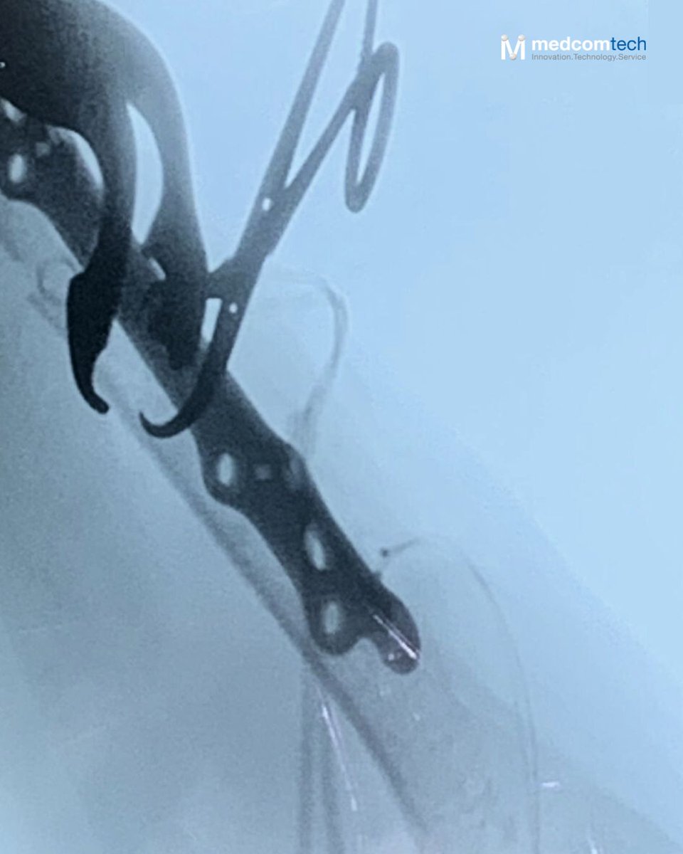 medcomtech_sa's tweet photo. Primer caso en el H. Arnau de Vilanova (Lleida) con placa periprotésica de húmero proximal de Intrauma. 
Intervención exitosa de la Dra. Bonjorn y el equipo EESS.
#traumatología #húmero #cirugíaortopédica #intrauma https://t.co/0NQu0Dyg3R